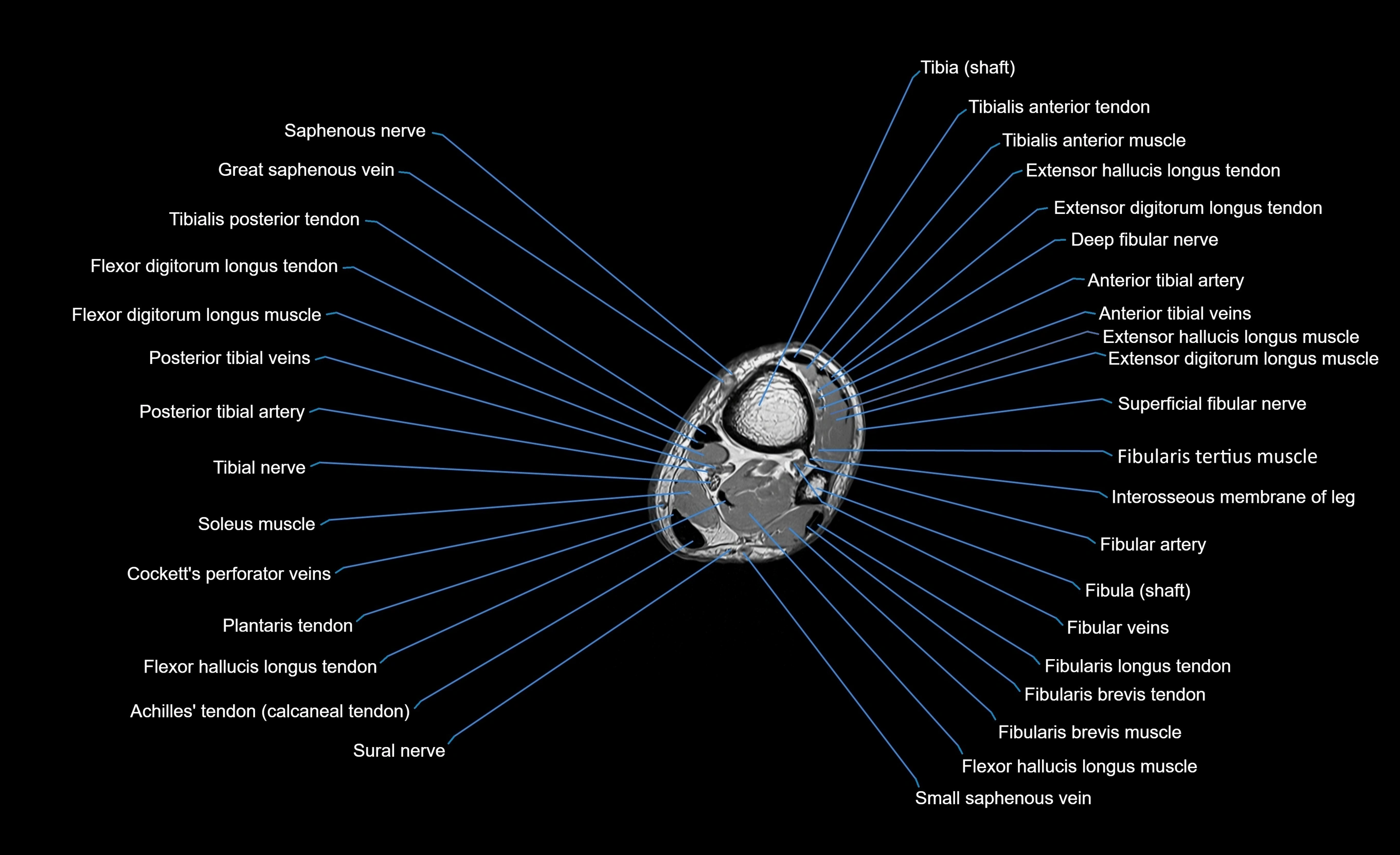 MRI lower leg axial cross sectional anatomy 3T  radiology  image-img-00001-00090.webp